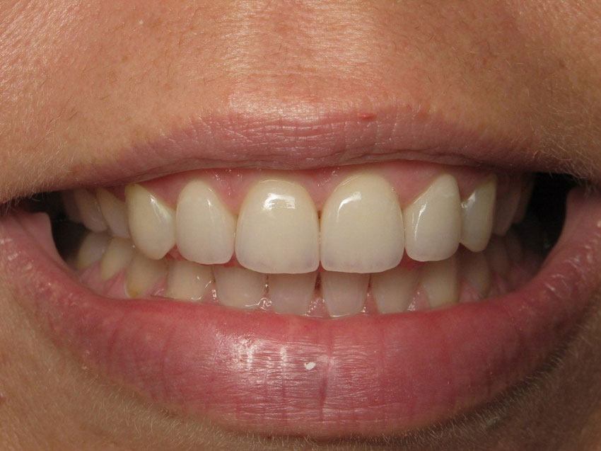 Same-day Dental Crowns In Marietta, GA - Gilreath Family Dentistry